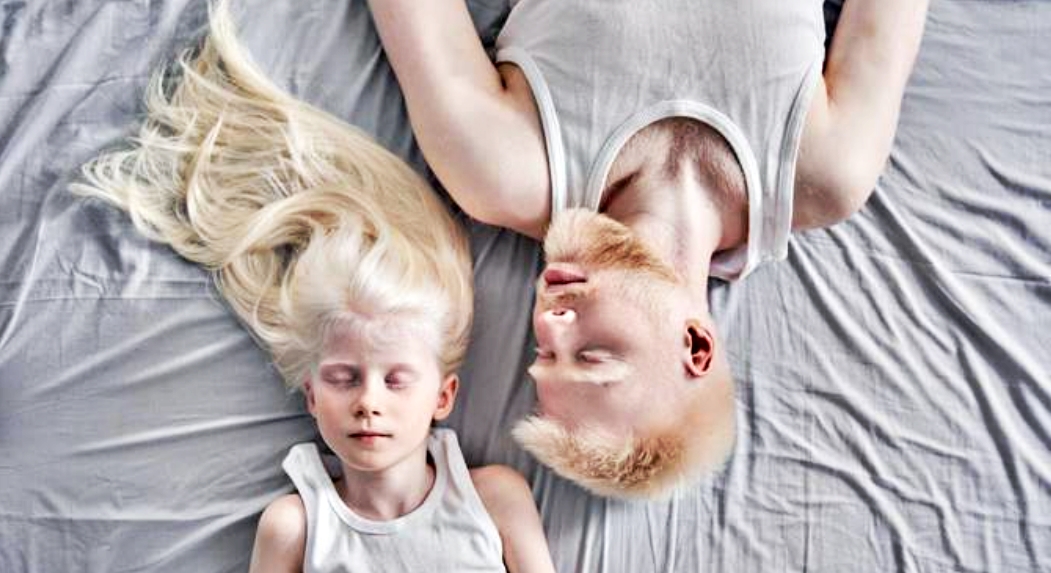 Geneticista da SES-AM explica a genética por trás da condição do albinismo