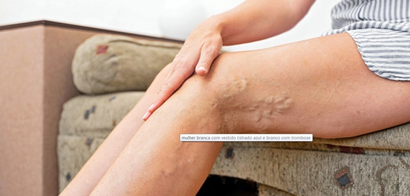 Uso de pílula anticoncepcional pode causar trombose?