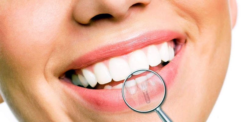 Mercado de implantes deve chegar a R$ 72 milhões em 2027